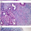 Acute Kidney Injury as the First Manifestation of Sarcoidosis [Published online Keio J Med, 74, 96-100, by J-STAGE]