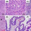 Poorly Differentiated Carcinoma with only Clear Glandular Differentiation Arising from the Bladder Trigone: A Case of Adenocarcinoma or Urothelial Carcinoma? [Published online Keio J Med, 74, 113-118, by J-STAGE]